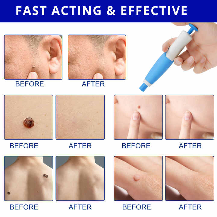 2 In1 Painless Auto Skin Tag Mole Removal Kit